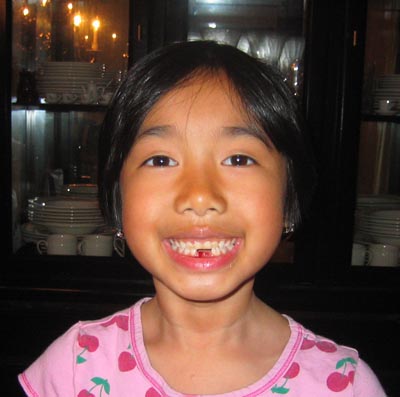 Missing Teeth
